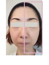 ソニョ(Sonyo)/スキンケアbefore after