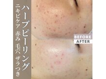 エテ(ete)の雰囲気（毛穴/ニキビケア/肌トーンも変化♪皮脂の多い男性にもおすすめ☆）