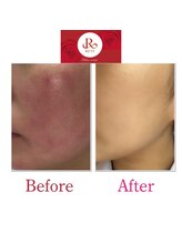 エム(M)/REVIハーブピーリング