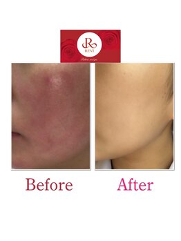 エム(M)/REVIハーブピーリング