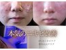 【ニキビ】本気改善フェイシャル