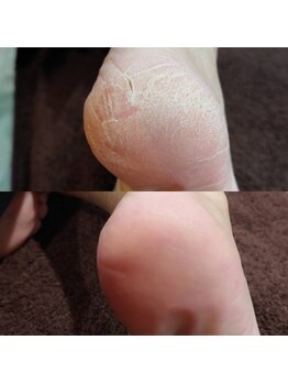 ボーソリューション(Beau-Solution)/【夏　ガサガサかかとケア】