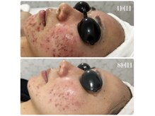 リアム(LiAm)/ニキビケア &nbsp;第4世代ララピール