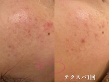 サロンヴェアリー 広尾(salon vary)/テクスパ水玉リフティング