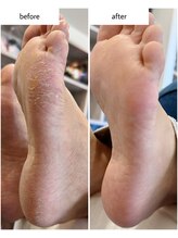 ケアプラス(care plus)/足裏角質ケア