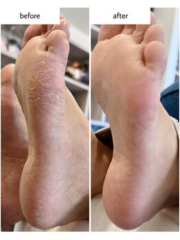 ケアプラス(care plus)/足裏角質ケア