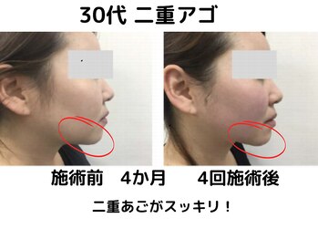 エンジェルエッグ/◆二重あごが解消されて小顔へ！