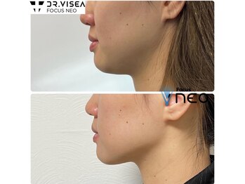 エイプリル/【蓄熱式超音波】比較写真