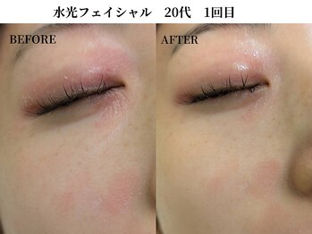 サンビ(SANBI)/保水で赤みを鎮静★