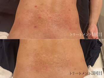 クリアヒーリングサロン/３０代トラブル肌ケア