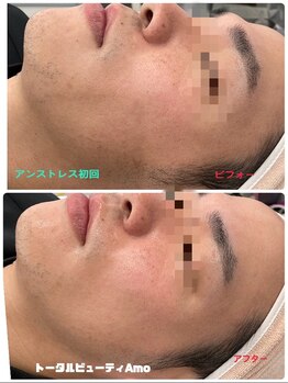 アモ(amo)/クリスティーナ【アンストレス】