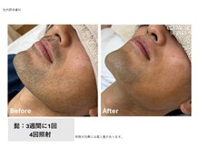 サロン アンネ(Anne)/高松市メンズ脱毛