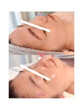 エテル(eter)/30代女性 水光ピール３回