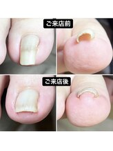 プレシオサ ネイル(Preciosa Nail)/巻き爪補正