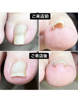 プレシオサ ネイル(Preciosa Nail)/巻き爪補正