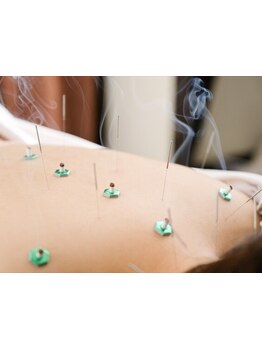 鍼灸施術を受けたい