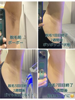 ワイズサロン(Y's salon)/ワキ脱毛経過