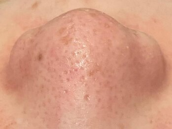 アクール(Accueil)の写真/加工なしでも怖くない！【つるすべお肌へ導く極上の90分¥26000→¥5980】毛穴レスで素肌にもっと自信を♪