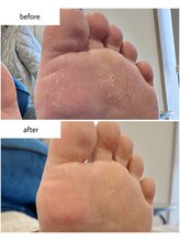 ケアプラス(care plus)/足裏角質ケア