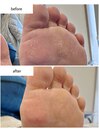 足裏角質ケア
