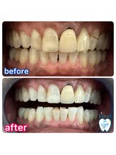 キラット 札幌中島公園店(Kiratt)/60代男性様初回before.after 