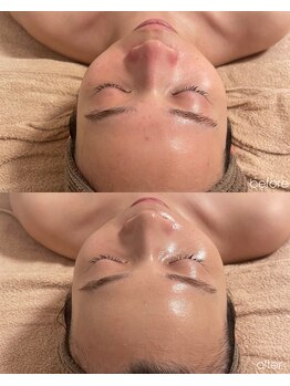 メロウ(mellou)/befove/after