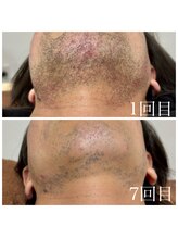 ランプ(LAMP)/～ハイブリッドヒゲ脱毛～