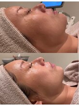 ビュウナ 銀座(BEAUNA)/マルチウェーブリフト