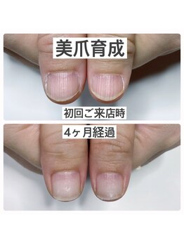 マニュコクーン(ManuCocoon)/爪育成 深爪 巻き爪 大阪市