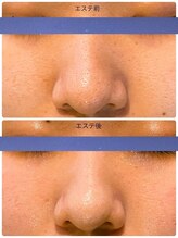 エステティックジュビラン アンビエンテ 福井南店/毛穴ケア＆毛穴洗浄、黒ずみ毛穴