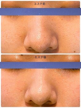 エステティックジュビラン アンビエンテ 福井南店/毛穴ケア&毛穴洗浄、黒ずみ毛穴