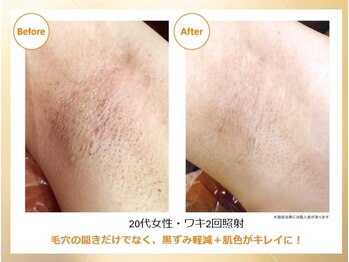 オワゾーブルー(Oiseaubleu)/20代/光脱毛2回照射