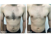 セラス(CERAS)/男性の胸部・お腹脱毛