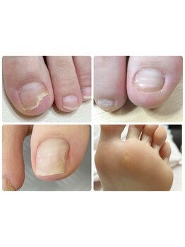 爪の悩みを解消できる（ケア含む）