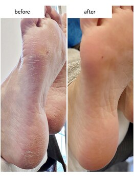 ケアプラス(care plus)/足裏角質ケア