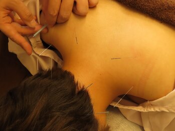 健康堂 道玄坂院の写真/【鍼灸施術に定評アリ◎】腰痛や首肩こりなどのお悩みから、顎周りデコルテをスッキリさせる美容鍼灸まで◎
