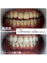 ホワイトニングサロン 京都烏丸店/ホワイトニング施術例