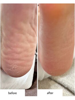 ケアプラス(care plus)/足裏角質ケア