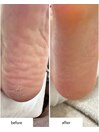 足裏角質ケア