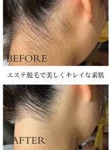 シャーロック(4869Sherlock)&nbsp;肌質改善 脱毛