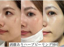 アリス(ALICE)/傷もハーブピーリングで回復