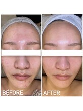 エステプリヴェモロッコ(ESTHE PRIVE MOROCCO)/BIOPHYTO 【ニキビ/赤み】