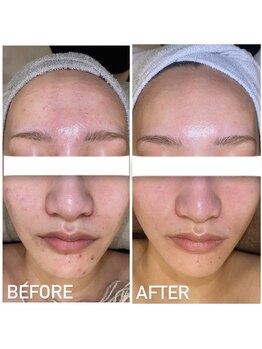 エステプリヴェモロッコ(ESTHE PRIVE MOROCCO)/BIOPHYTO 【ニキビ/赤み】