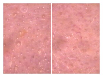 ベル(Bell)/毛穴洗浄