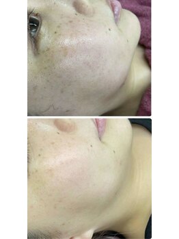 ハッテンビューティーパーク 神戸店(Hatten Beauty Park 810)/【ナノBirodo瞬時美白・保湿】