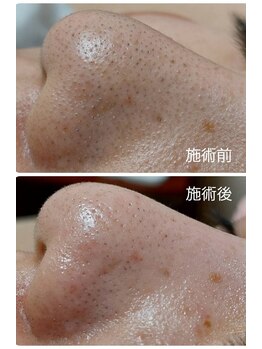 ビアンカーラ(Biancara)/浮き出る【韓国式3D毛穴洗浄】