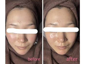 マリーメリー(marie merry)/艶肌wax＋プラズマシャワー