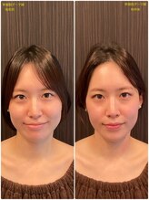 はる鍼灸整骨院/驚愕のダーマ鍼！　美容鍼