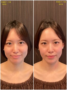 はる鍼灸整骨院/20代女性｜1回の結果