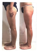 サーズ(SA’S)/下半身集中カッピング